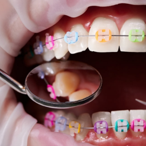 dental force sensors for orthodontics